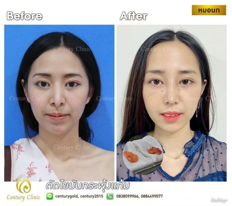 Review ตัดไขมันกระพุ้งแก้ม1-CenturyClinic