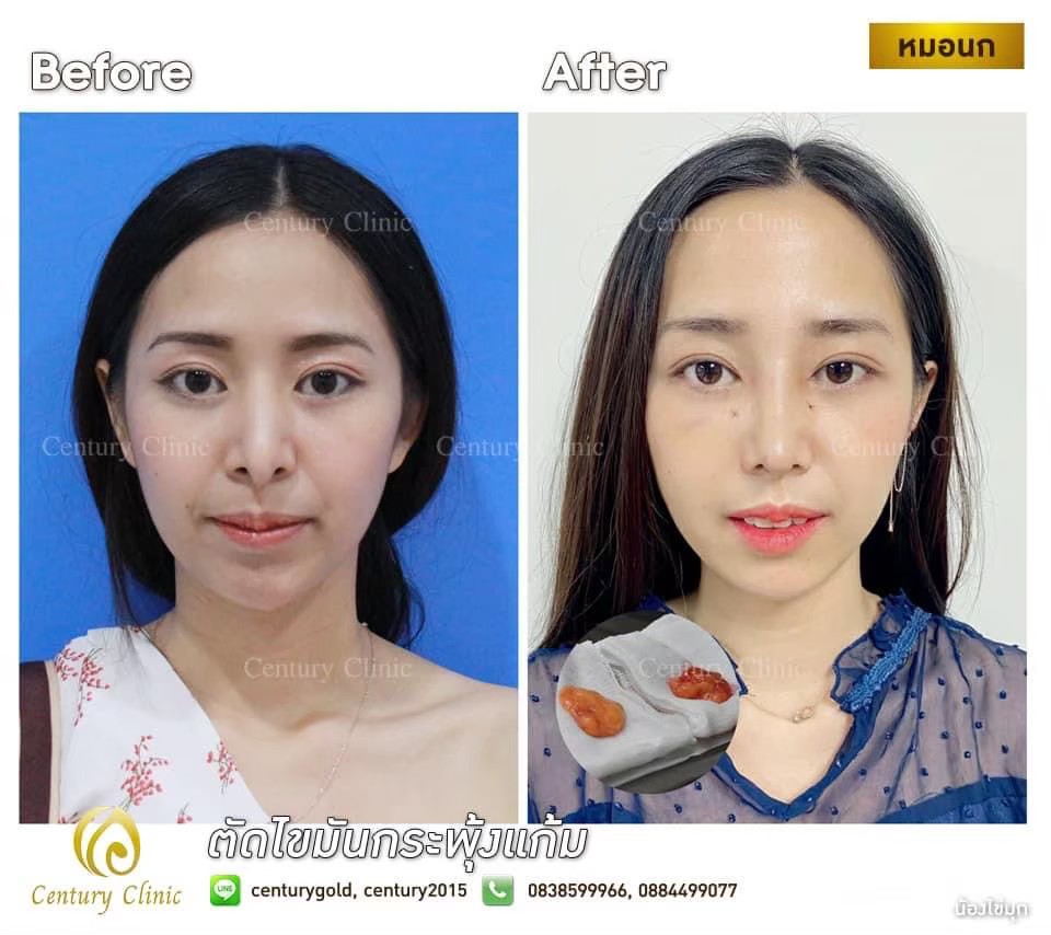 รีวิว ตัดไขมันกระพุ้งแก้ม #1 , Century Clinic Thailand Review ตัดไขมันกระพุ้งแก้ม1-CenturyClinic