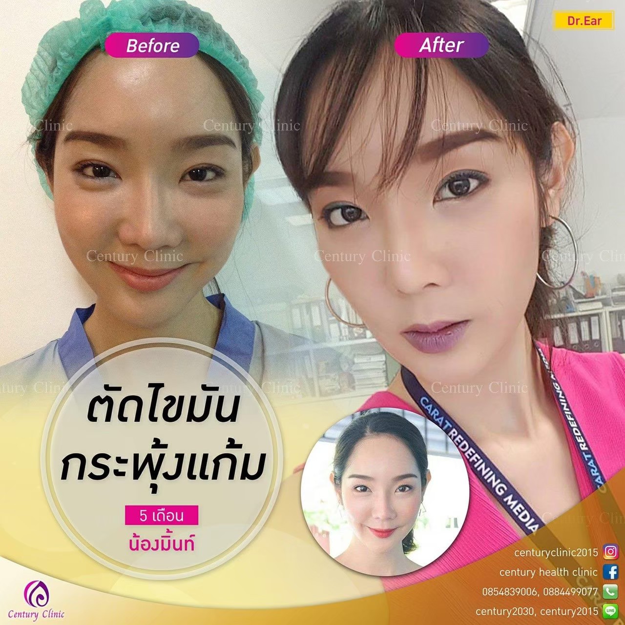 รีวิว ตัดไขมันกระพุ้งแก้ม #3 , Century Clinic Thailand Review ตัดไขมันกระพุ้งแก้ม3-CenturyClinic