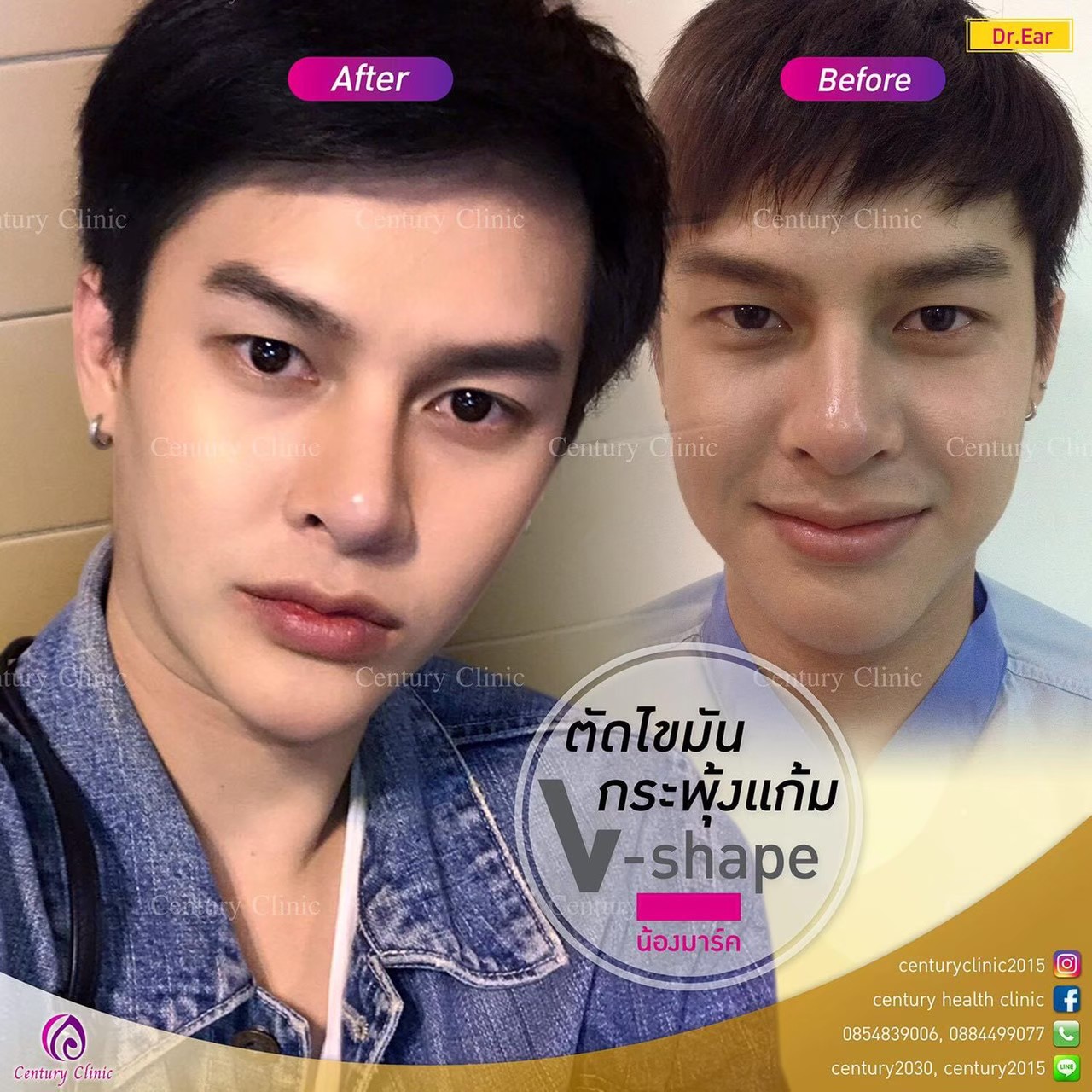 Review ตัดไขมันกระพุ้งแก้ม4-CenturyClinic