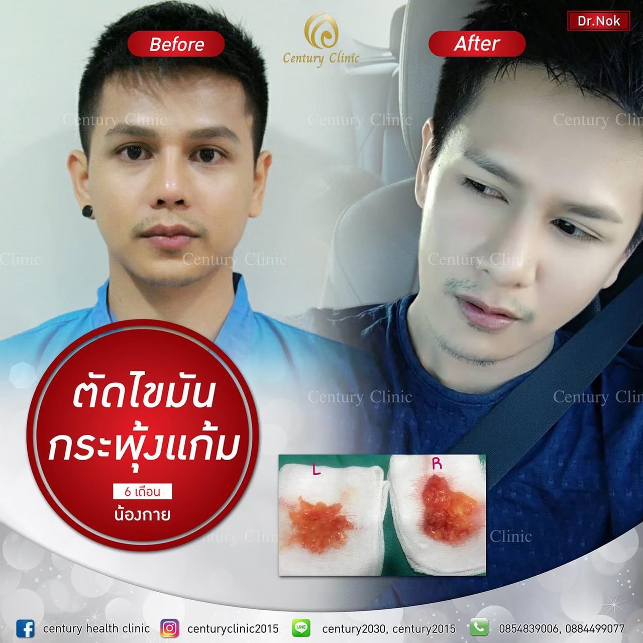 Review ตัดไขมันกระพุ้งแก้ม5-CenturyClinic