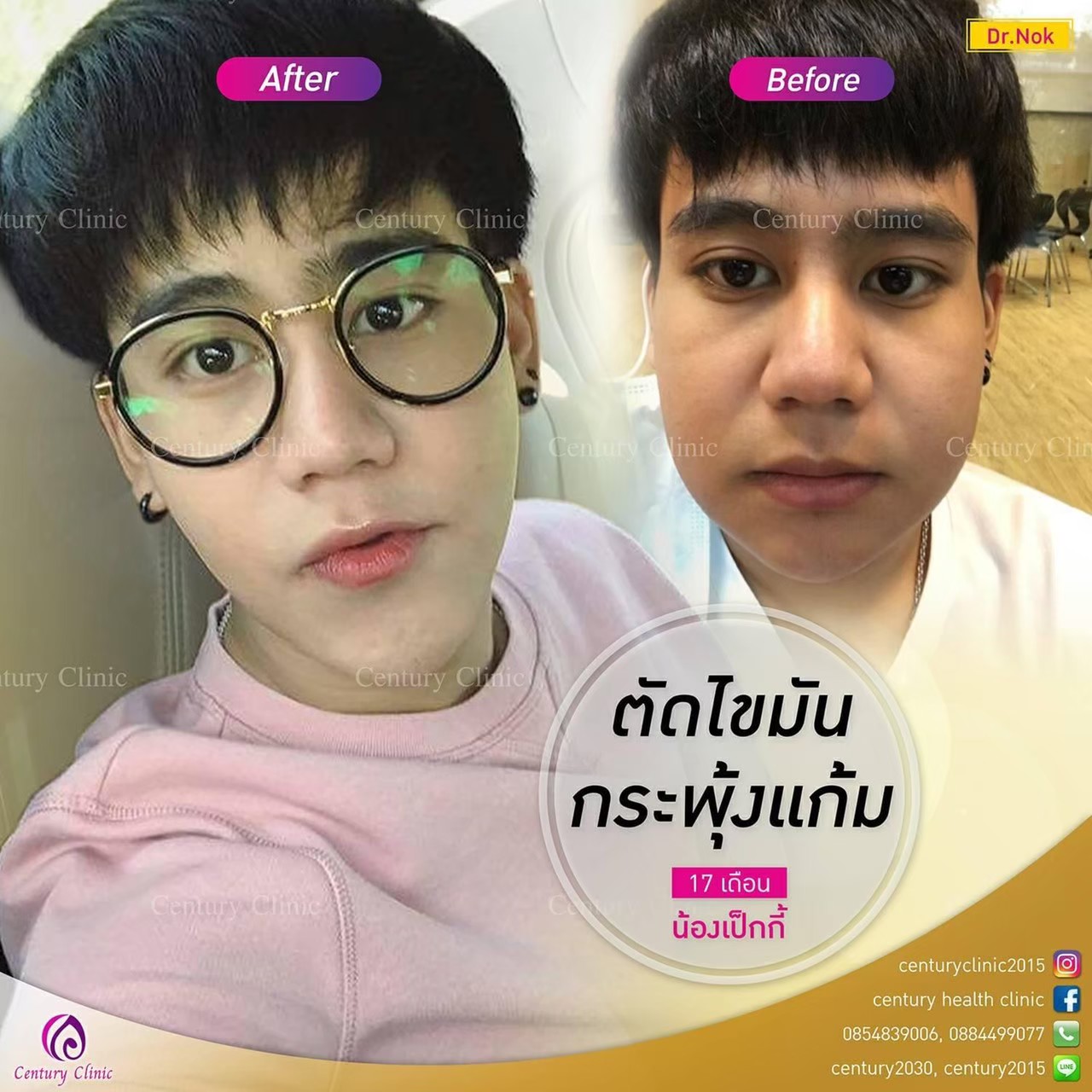 รีวิว ตัดไขมันกระพุ้งแก้ม #6 , Century Clinic Thailand Review ตัดไขมันกระพุ้งแก้ม6-CenturyClinic