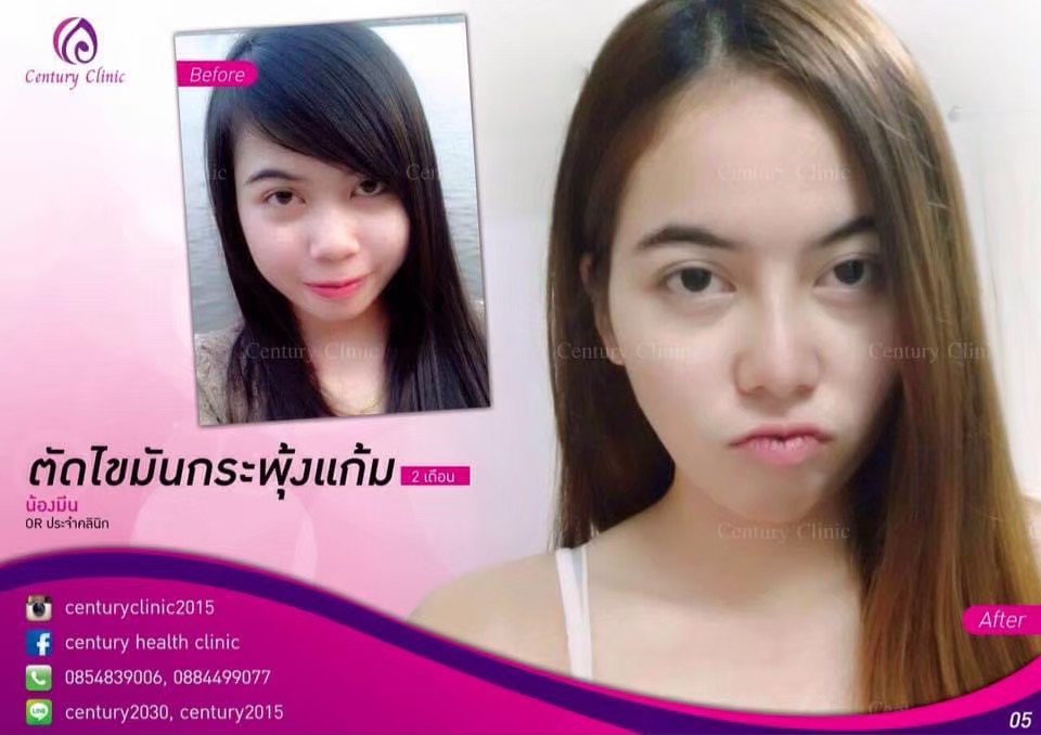 Review ตัดไขมันกระพุ้งแก้ม7-CenturyClinic