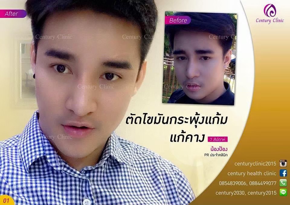 Review ตัดไขมันกระพุ้งแก้ม8-CenturyClinic