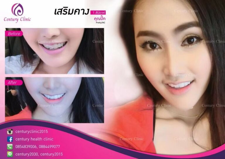 รีวิว เสริมคาง2-Century