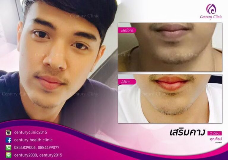 รีวิว เสริมคาง3-Century