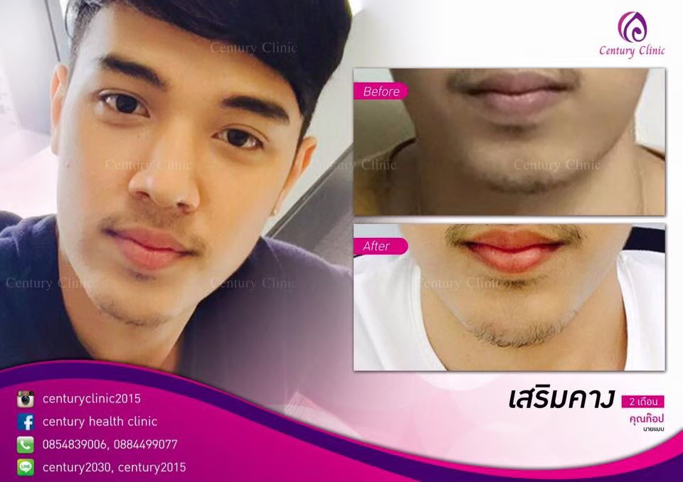 รีวิว เสริมคาง3-Century