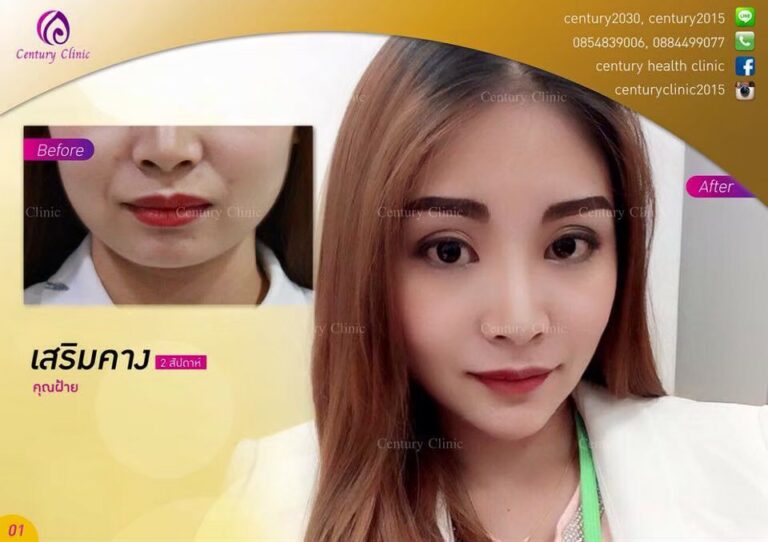 รีวิว เสริมคาง4-Century