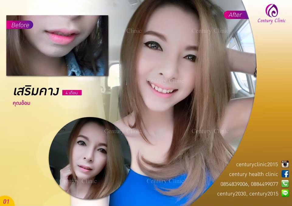รีวิว เสริมคาง5-Century