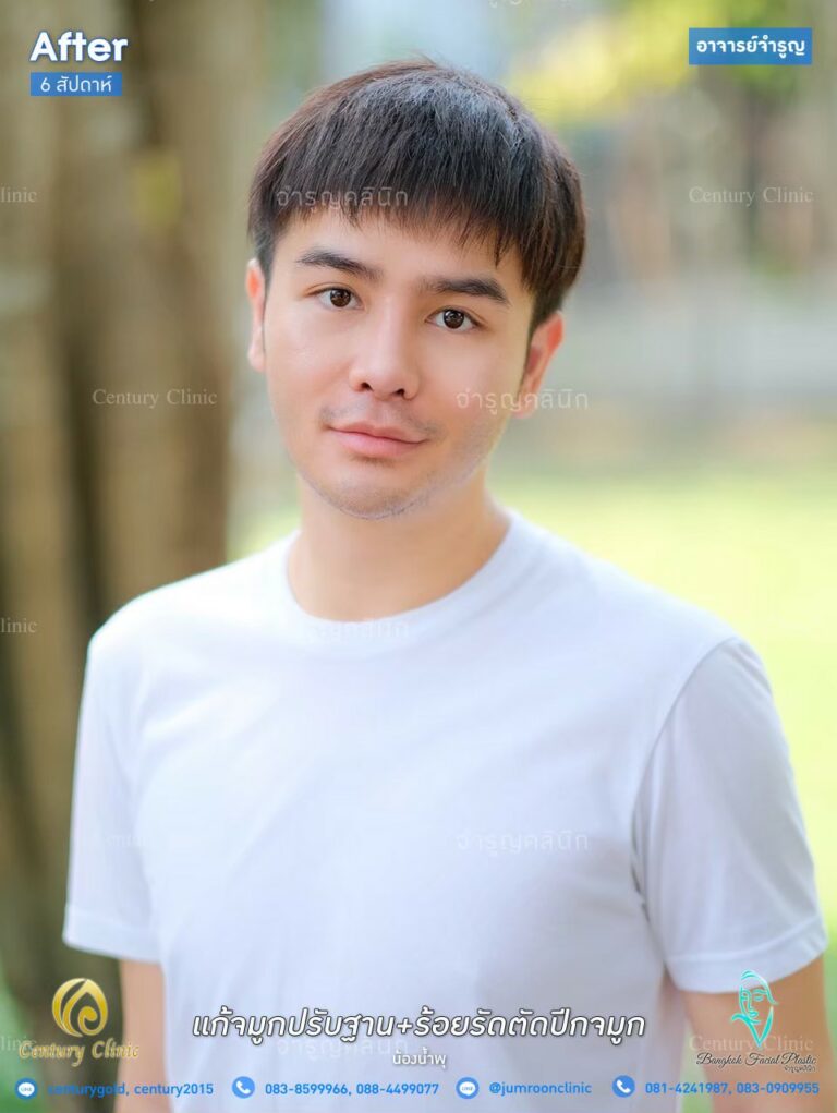 รีวิว เสริมจมูก1.3-CenturyClinic