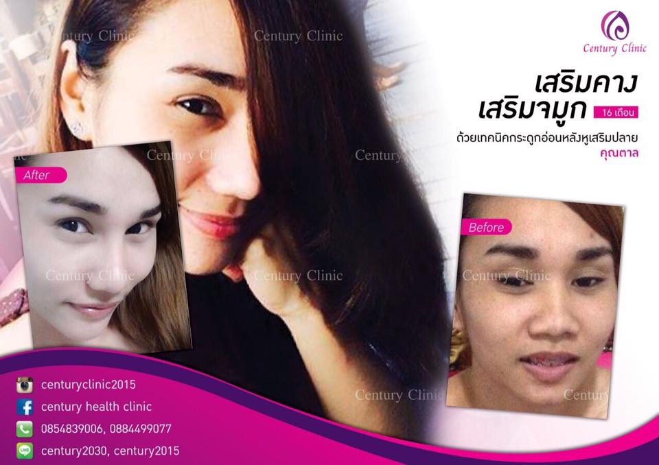 รีวิว เสริมจมูก และเสริมคาง #10 , Century Clinic Thailand รีวิว เสริมจมูก10-CenturyClinic
