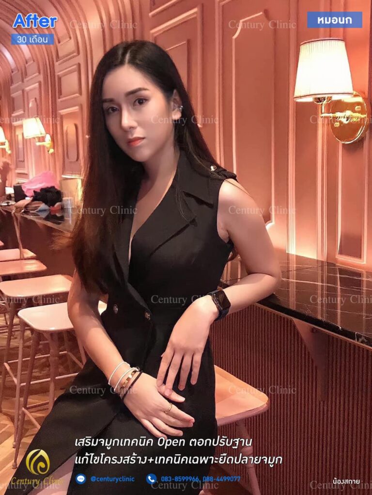รีวิว เสริมจมูก4-CenturyClinic