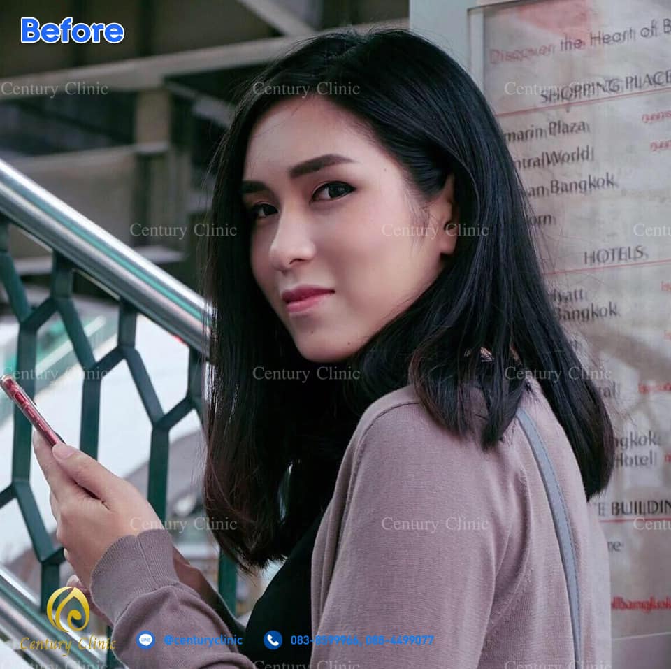 รีวิว เสริมจมูก4.2-CenturyClinic