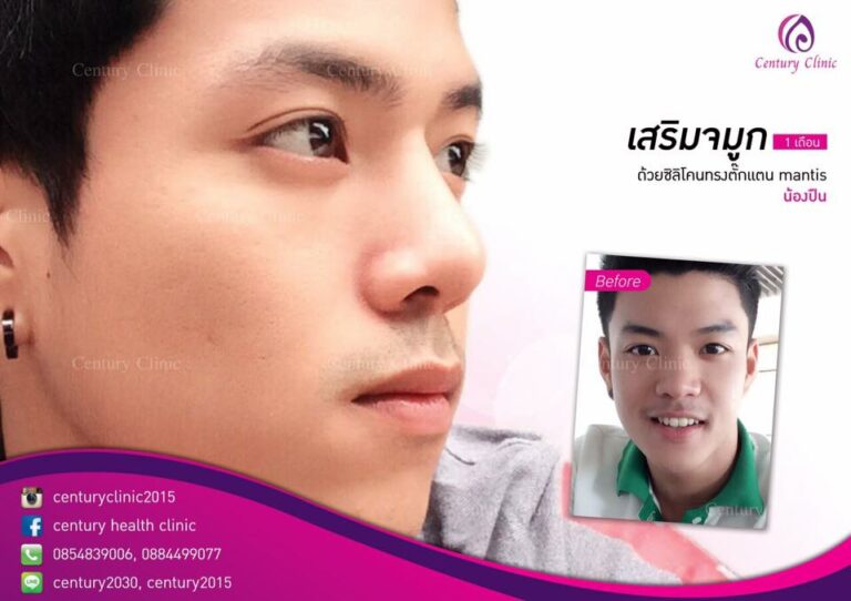 รีวิว เสริมจมูก5-CenturyClinic