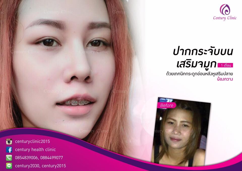 รีวิว เสริมจมูก6-CenturyClinic