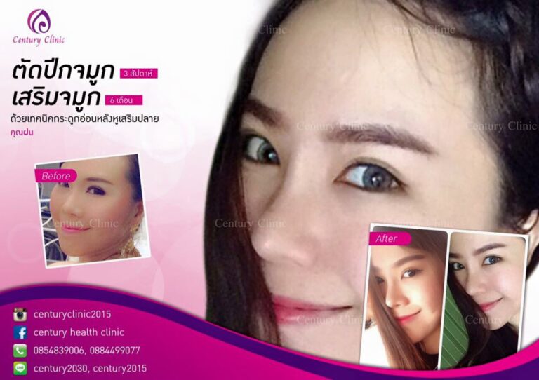 รีวิว เสริมจมูก7-CenturyClinic