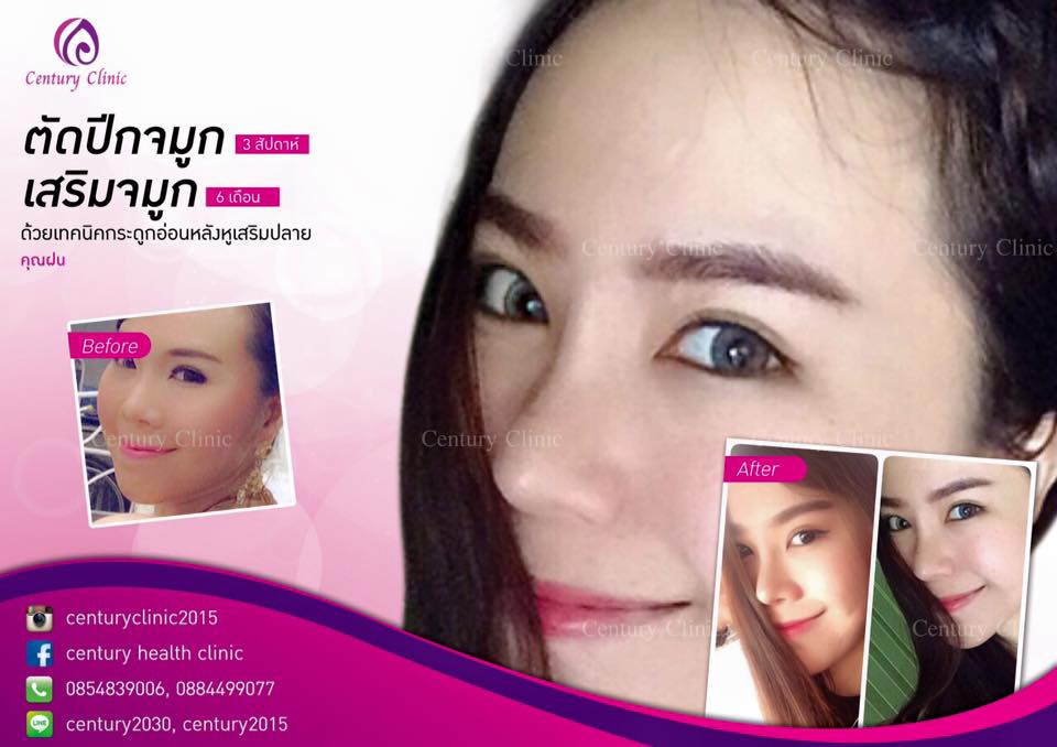 รีวิว เสริมจมูก7-CenturyClinic