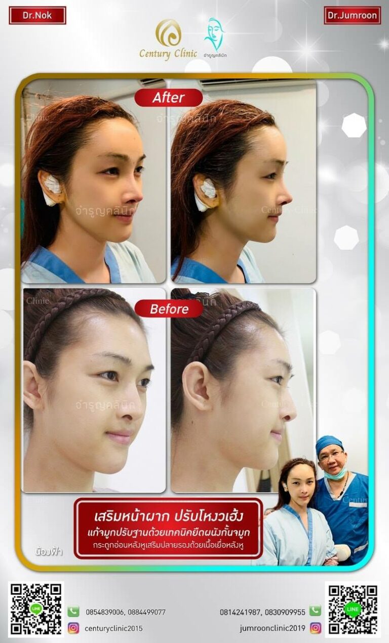 รีวิว เสริมหน้าผาก7-CenturyClinic