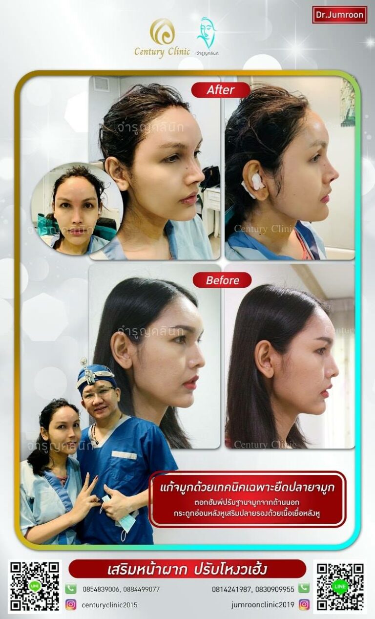 รีวิว เสริมหน้าผาก8-CenturyClinic
