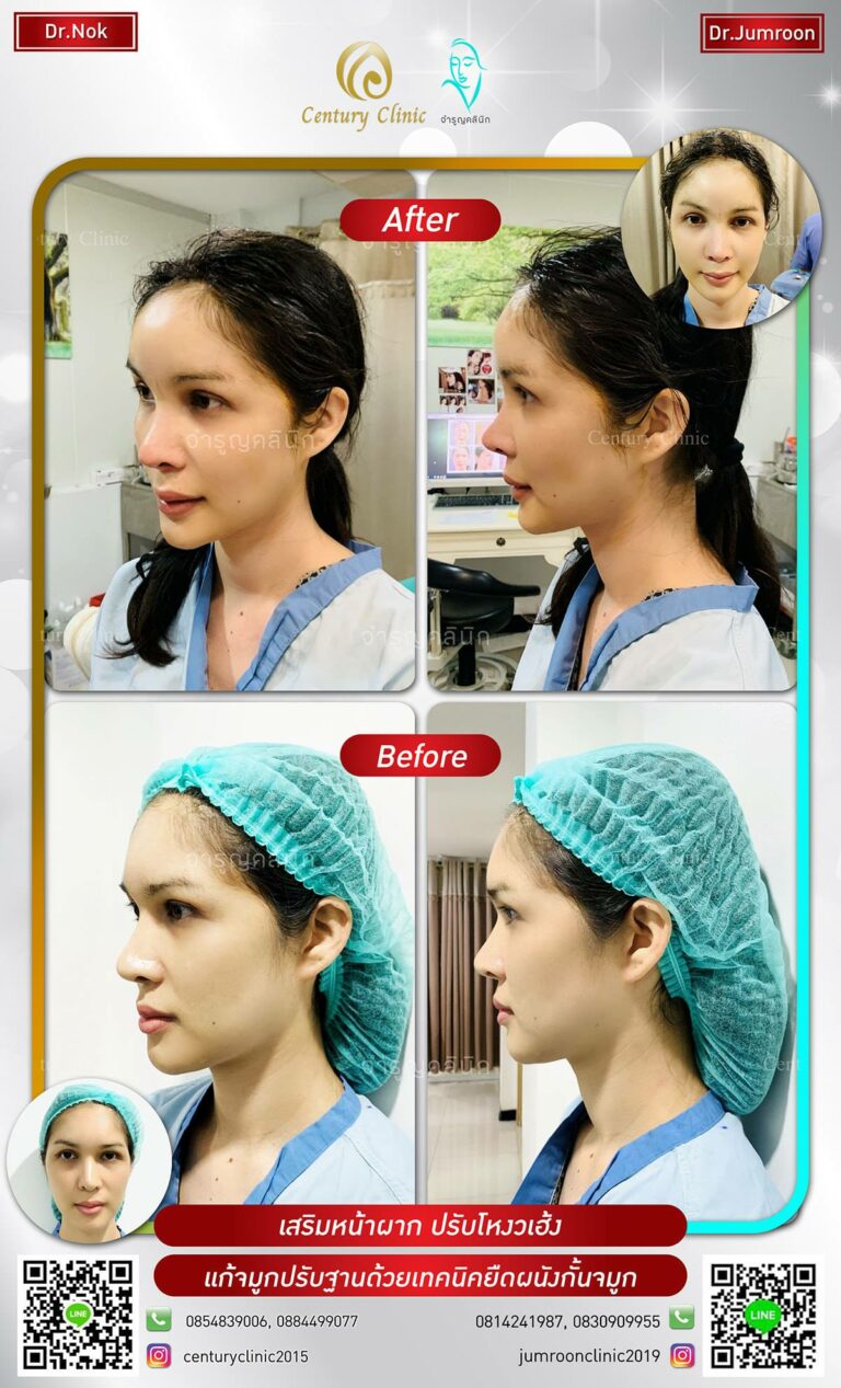 รีวิว เสริมหน้าผาก9-CenturyClinic