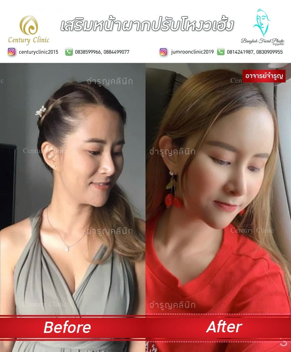 รีวิว เสริมหน้าผากปรับโหงวเฮ้ง6-CenturyClinic