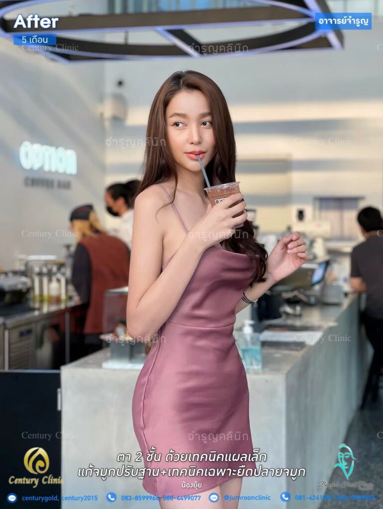 รีวิว แก้จมูกปรับฐาน #3 , Century Clinic Thailand รีวิว แก้จมูกปรับฐาน1.2-CenturyClinic