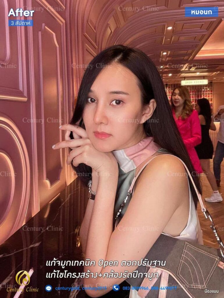รีวิว แก้จมูกเทคนิค Open ตอกปรับฐาน2.2-CenturyClinic