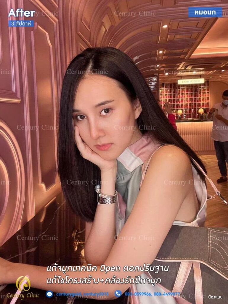 รีวิว แก้จมูกเทคนิค Open ตอกปรับฐาน2.2-CenturyClinic