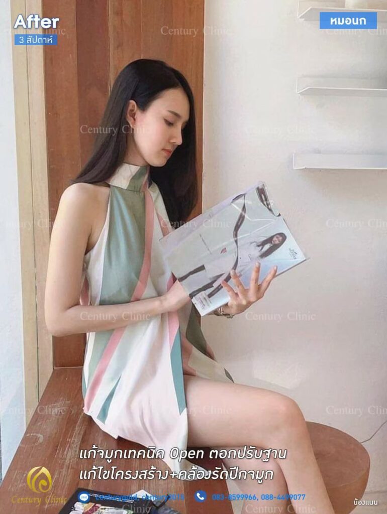 รีวิว แก้จมูกเทคนิค Open ตอกปรับฐาน2.3-CenturyClinic