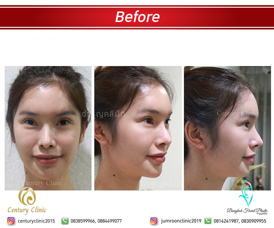 รีวิว แก้หน้าผากขูดสารเหลว3.2-CenturyClinic