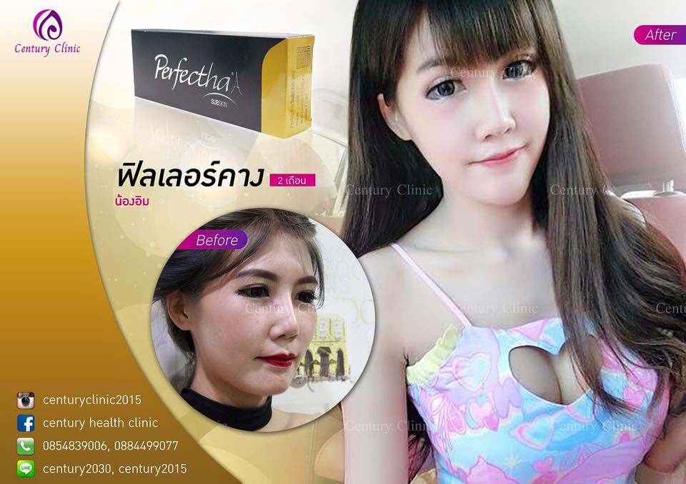 รีวิว ฉีดฟิลเลอร์คาง #2 , Century Clinic Thailand รีวิว ฉีดฟิลเลอร์คาง 2-CenturyClinic