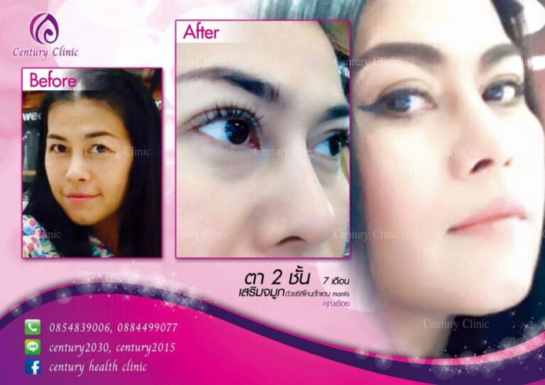 รีวิว ตาสองชั้น 1-CenturyClinic
