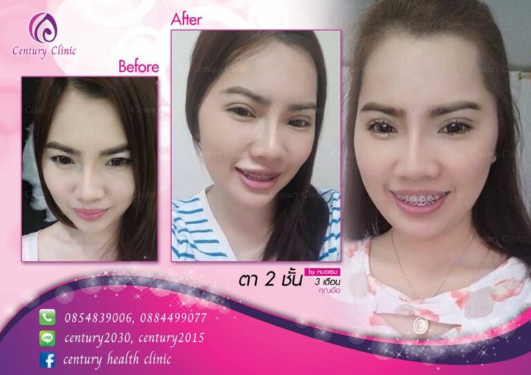 รีวิว ตาสองชั้น 2-CenturyClinic
