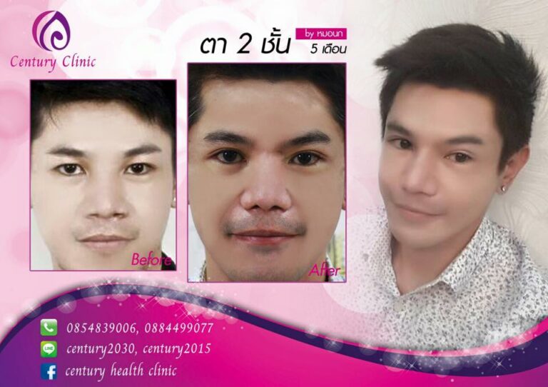 รีวิว ตาสองชั้น 3-CenturyClinic