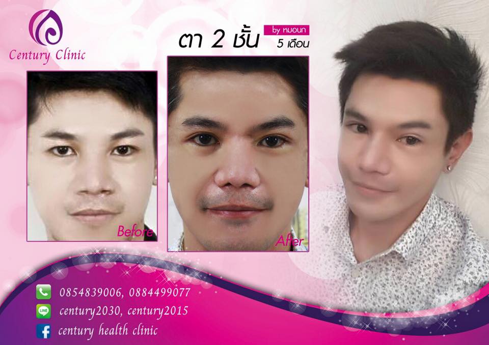 รีวิว ตาสองชั้น #3 , Century Clinic Thailand รีวิว ตาสองชั้น 3-CenturyClinic