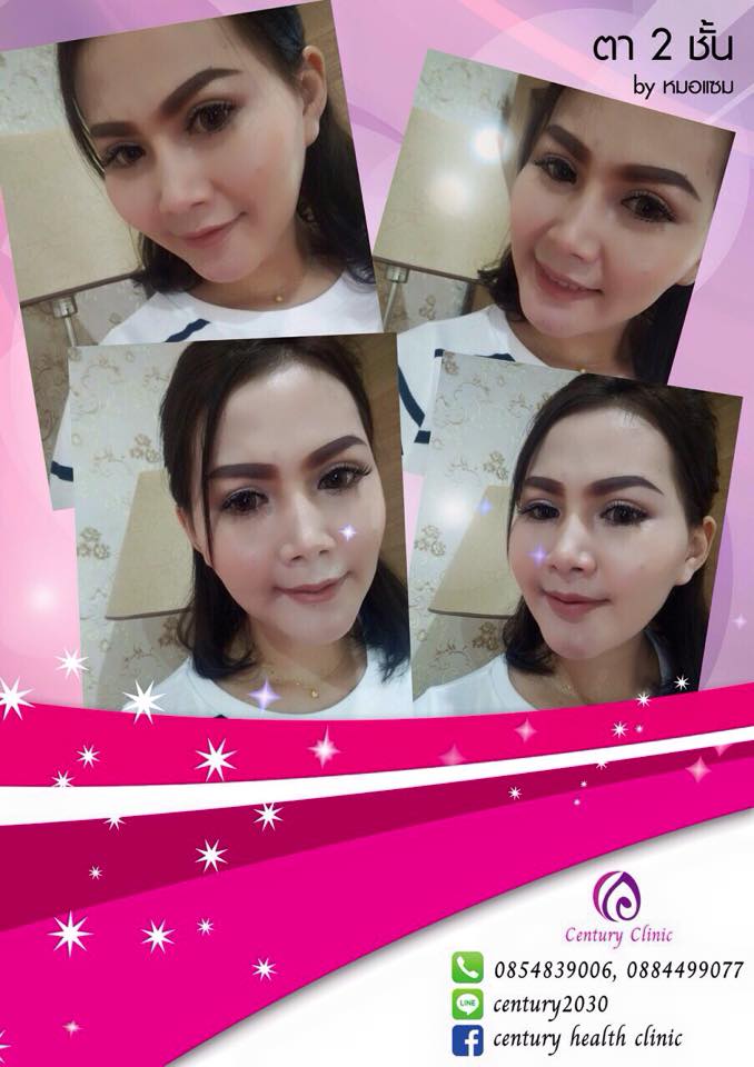 รีวิว ตาสองชั้น 4-CenturyClinic