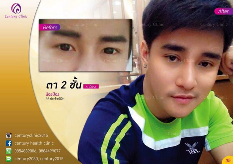 รีวิว ตาสองชั้น 5-CenturyClinic