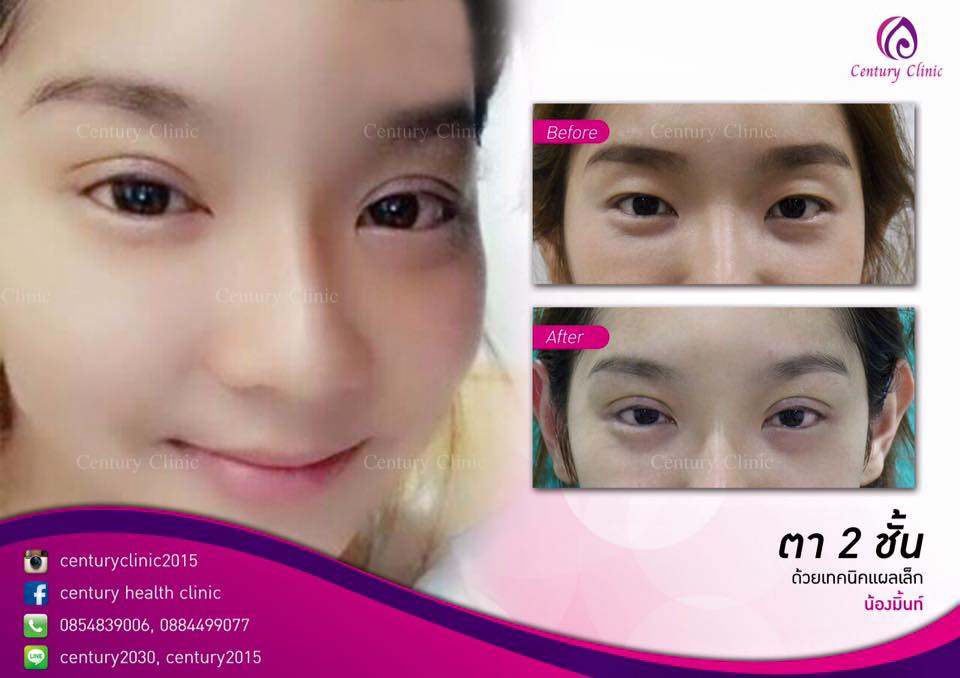 รีวิว ตาสองชั้น 6-CenturyClinic