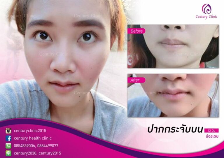รีวิว ปากกระจับบน 1-CenturyClinnic