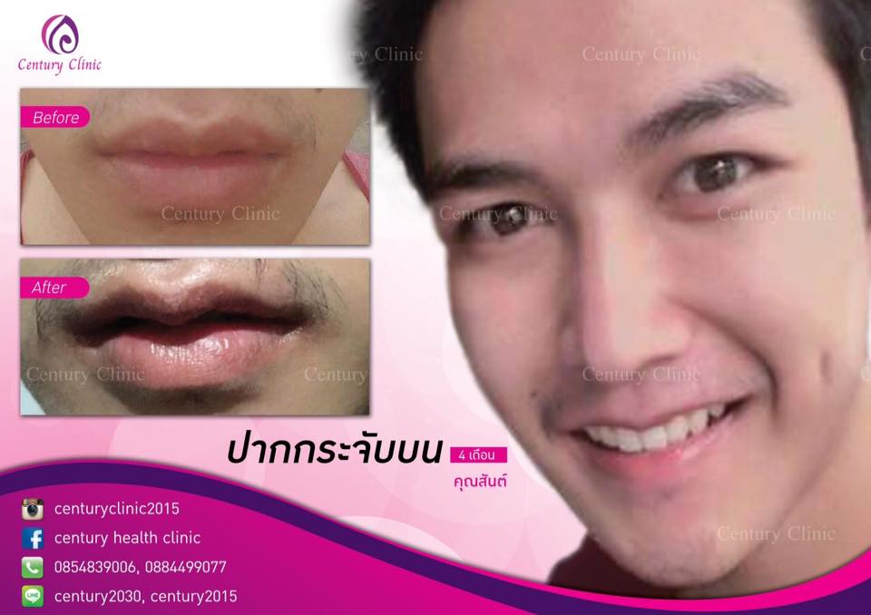 รีวิว ปากกระจับบน 2-CenturyClinnic
