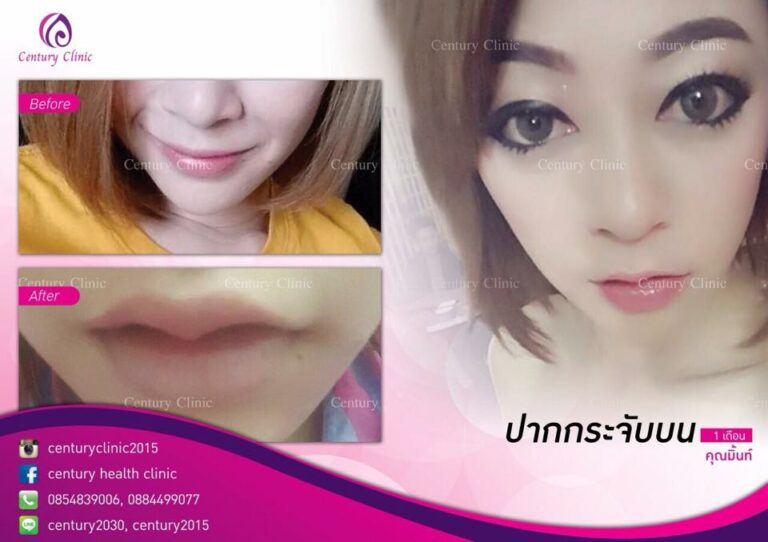 รีวิว ปากกระจับบน 3-CenturyClinnic