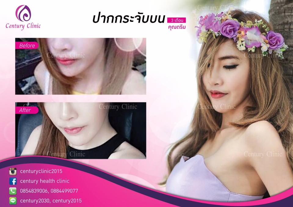 รีวิว ปากกระจับบน 4-CenturyClinnic