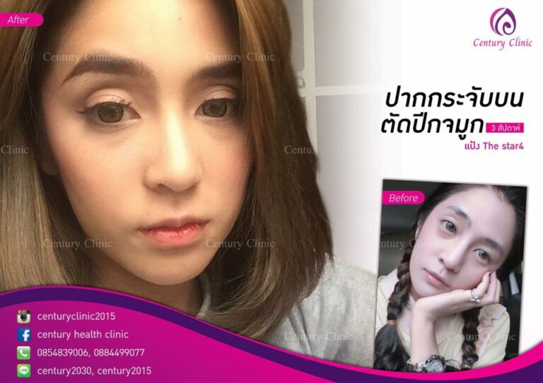 รีวิว ปากกระจับบน 5-CenturyClinnic
