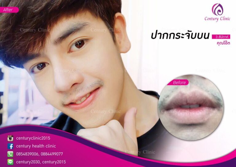รีวิว ปากกระจับบน 6-CenturyClinnic