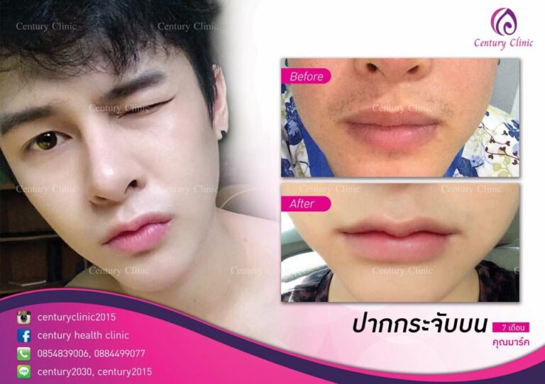 รีวิว ปากกระจับบน 7-CenturyClinnic