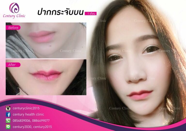 รีวิว ปากกระจับบน 8-CenturyClinnic