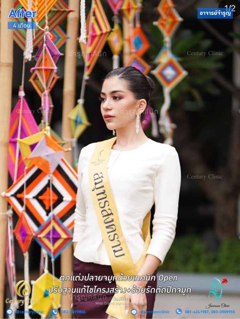 รีวิว เสริมจมูก11-2 CenturyClinic