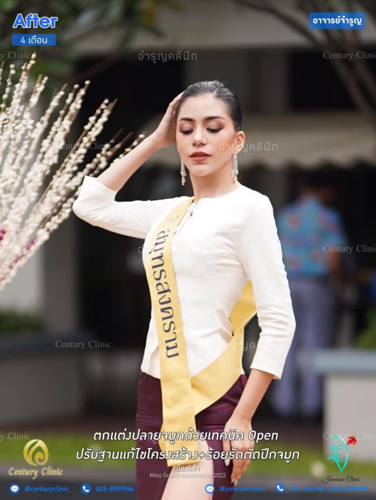 รีวิว เสริมจมูก11-3 CenturyClinic