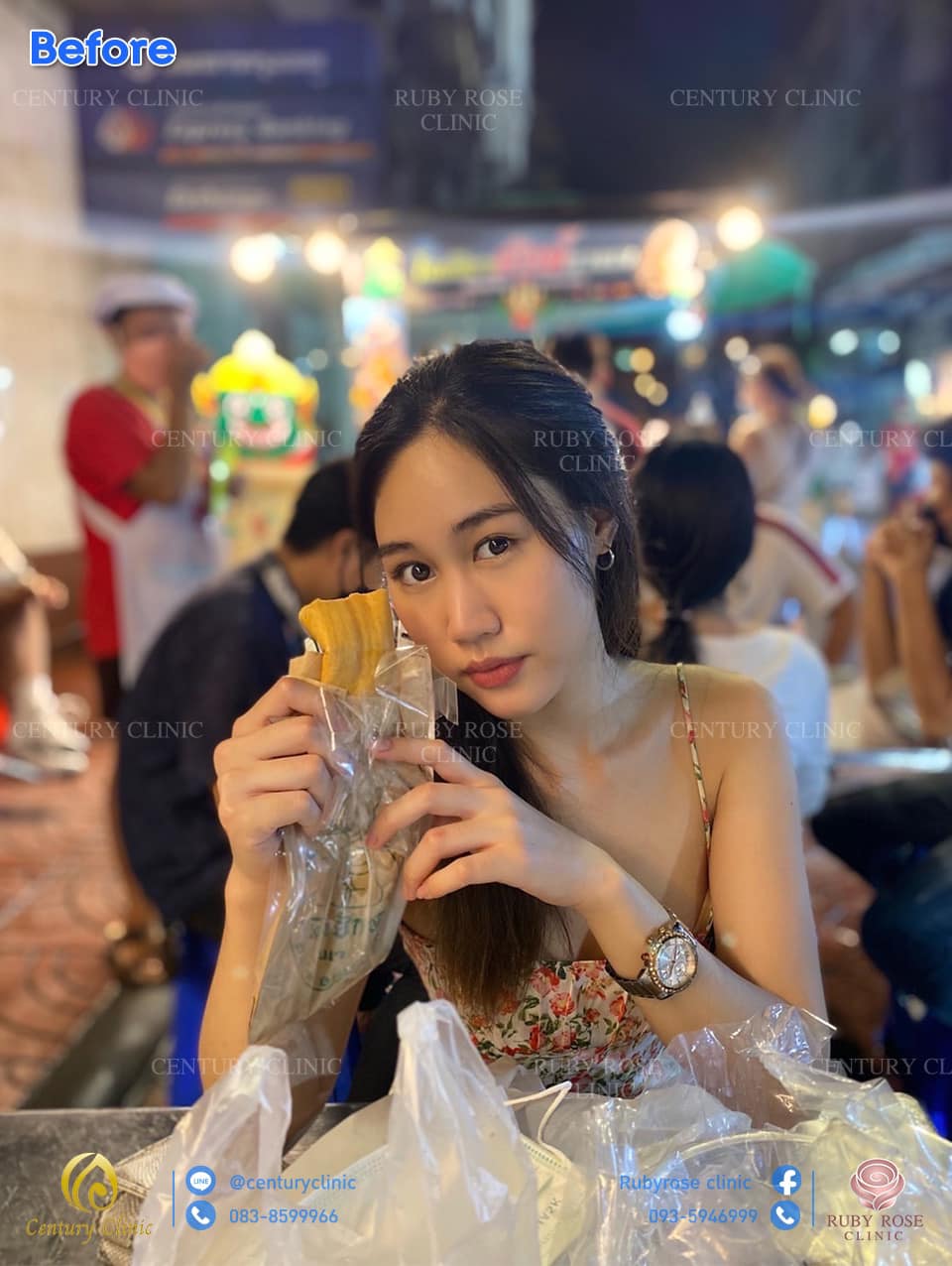 รีวิว เสริมจมูก17-3 CenturyClinic