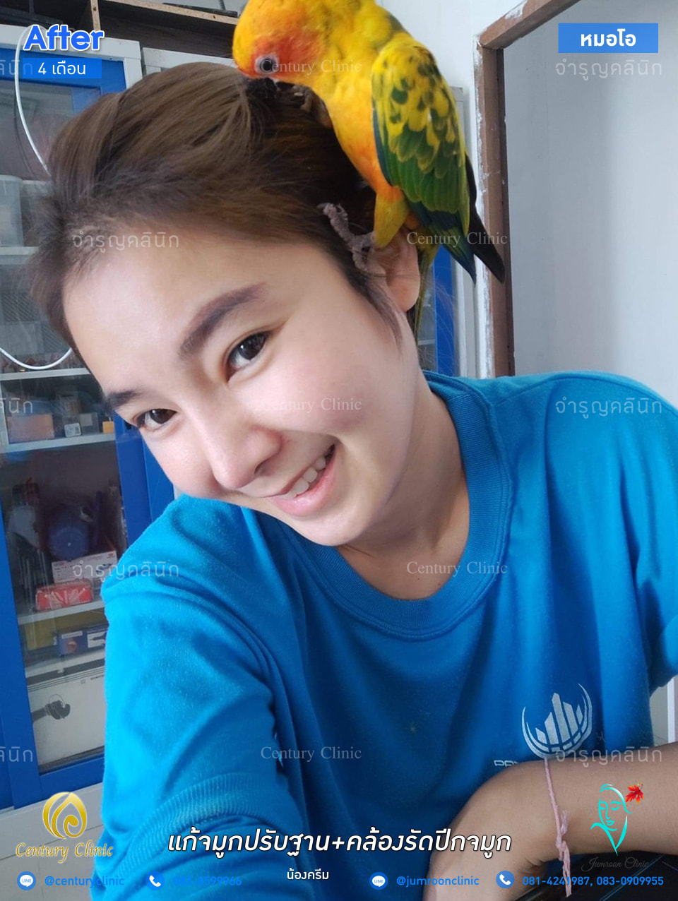 รีวิว เสริมจมูก20 CenturyClinic